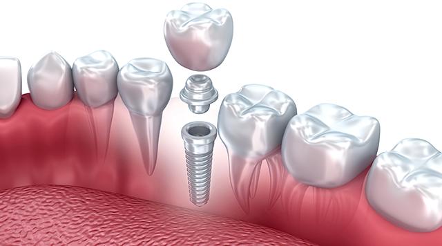 Come scegliere un impianto dentale?