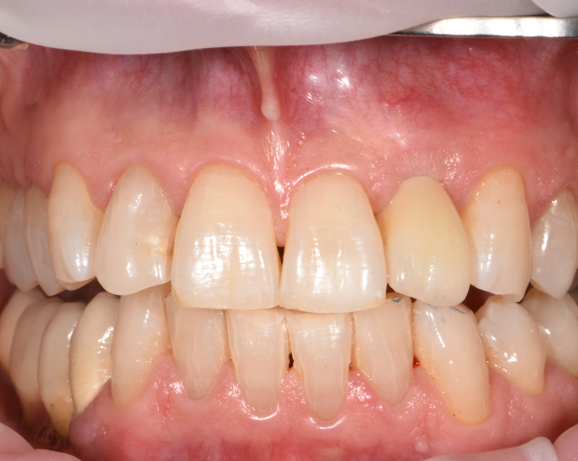 FP1 (o ponte circolare su impianti)