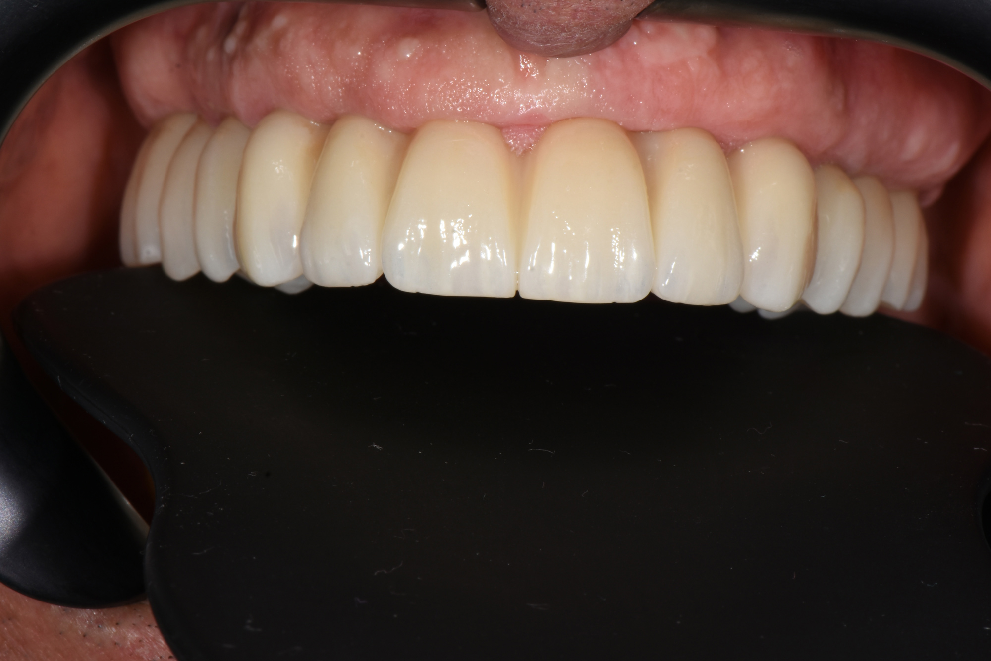 FP2 (o ponte circolare su impianti)